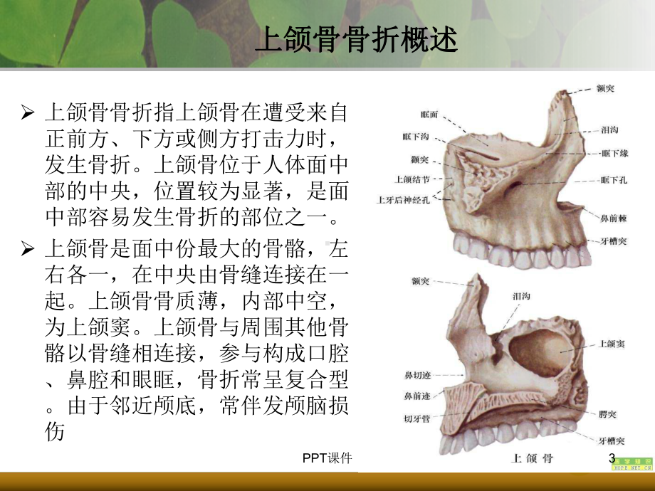 上下颌骨骨折-ppt课件.ppt_第3页