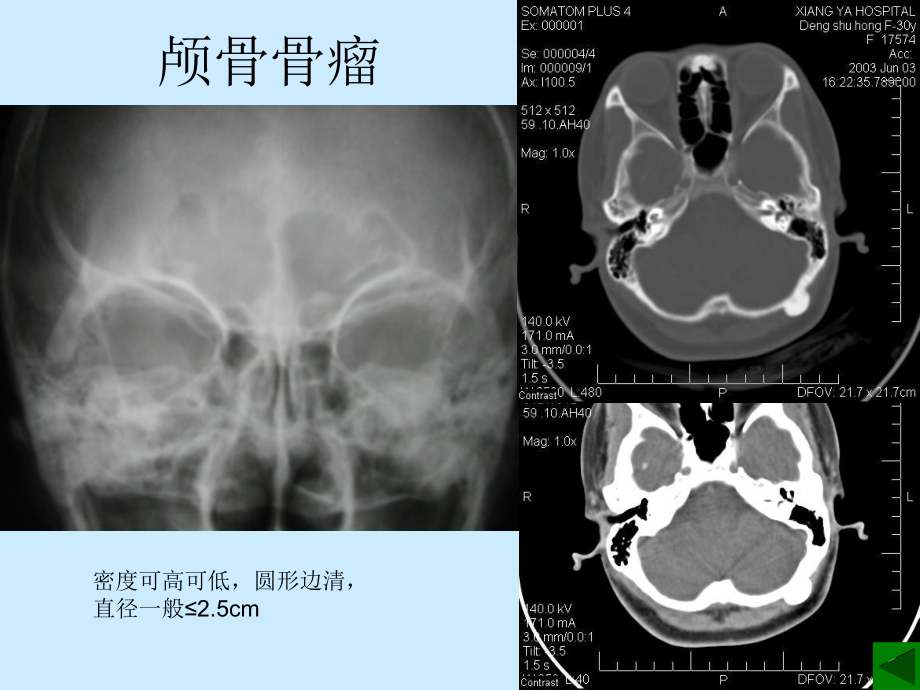 良性骨肿瘤影像诊断课件.ppt_第3页