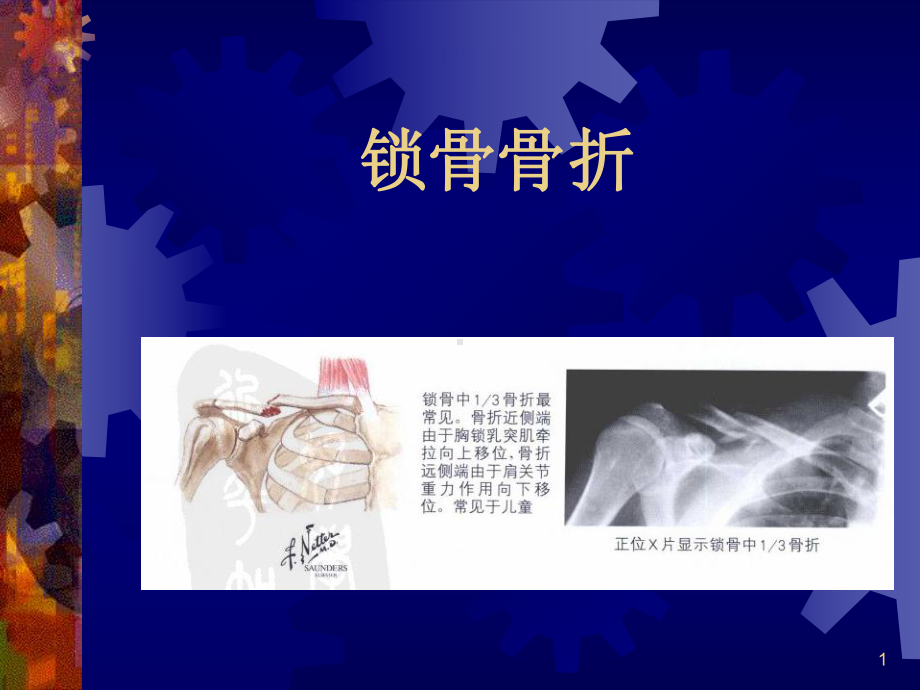 锁骨骨折课件.ppt_第1页