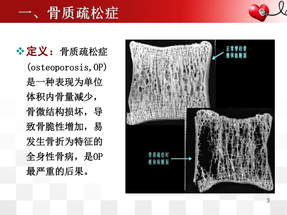 老年骨质疏松性胸腰椎压缩性骨折PPT课件.ppt_第3页