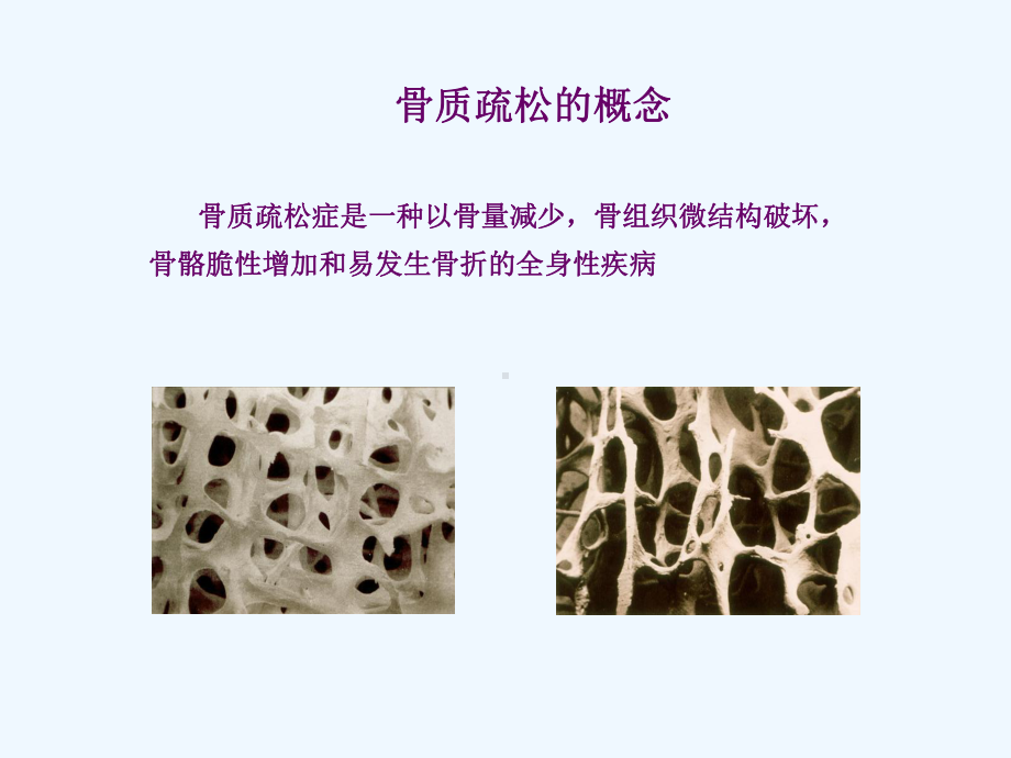 骨质疏松症及伊班膦酸钠的应用课件.ppt_第2页