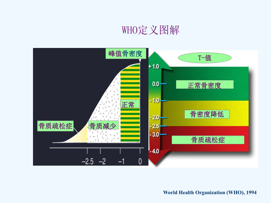 骨质疏松症及伊班膦酸钠的应用课件.ppt_第3页