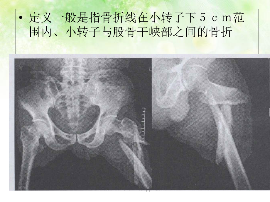 股骨转子下骨折-ppt课件.ppt_第2页