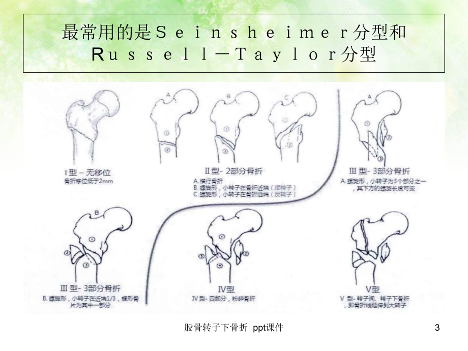 股骨转子下骨折-ppt课件.ppt_第3页