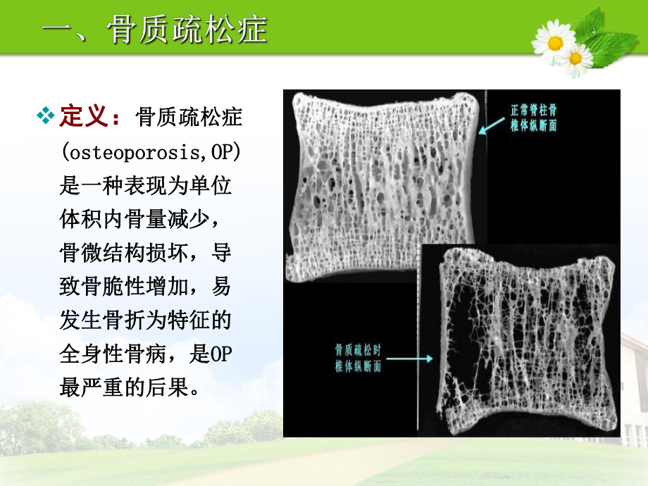 老年骨质疏松性胸腰椎压缩性骨折课件.ppt_第3页