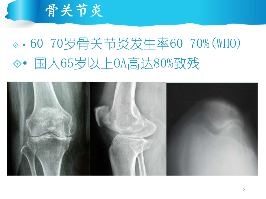 膝关节骨性关节炎的关节镜镜治疗PPT课件.pptx_第2页