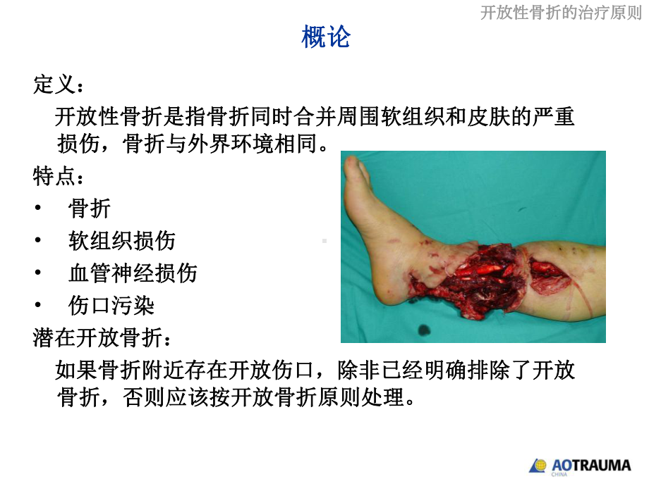 开放性骨折的治疗原则PPT课件.ppt_第3页