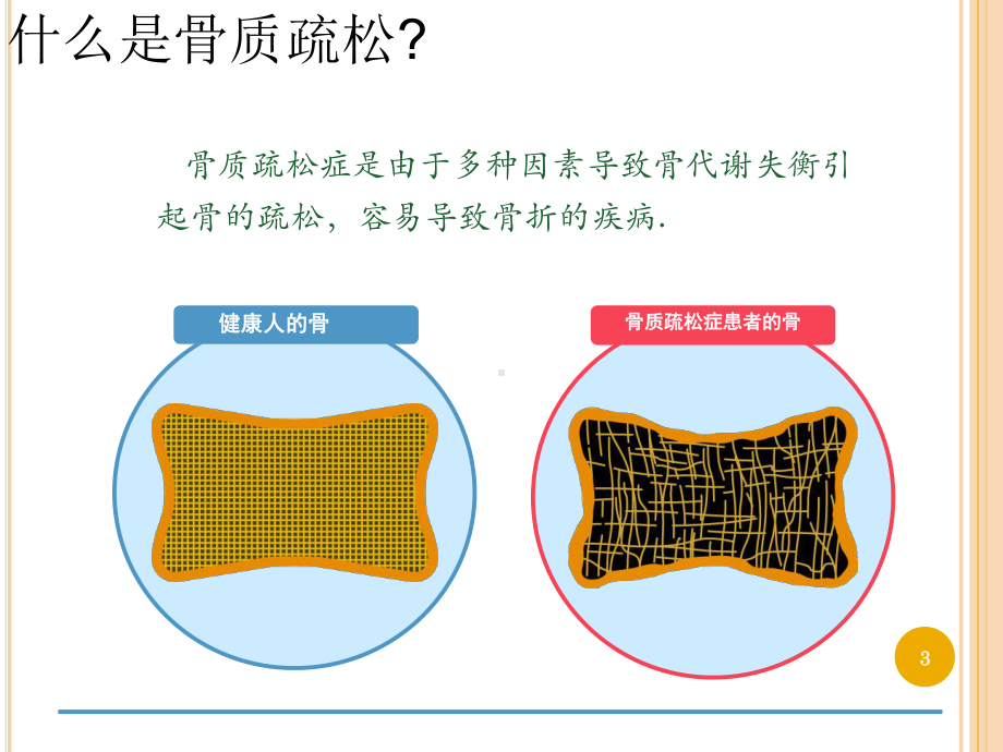 骨质疏松健康教育ppt课件.ppt_第3页