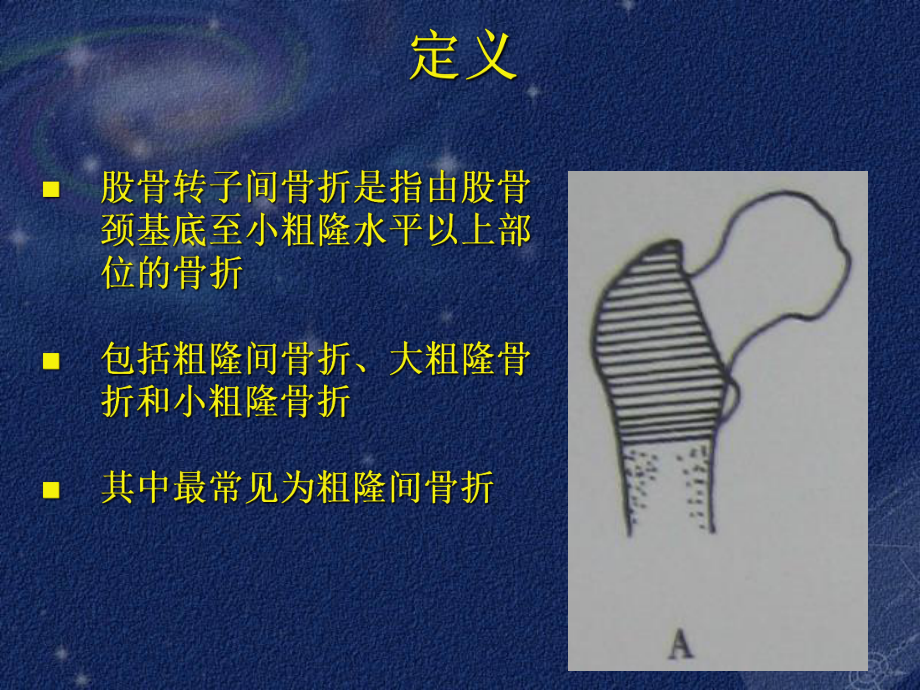 股骨转子间骨折的治疗课件.ppt_第2页