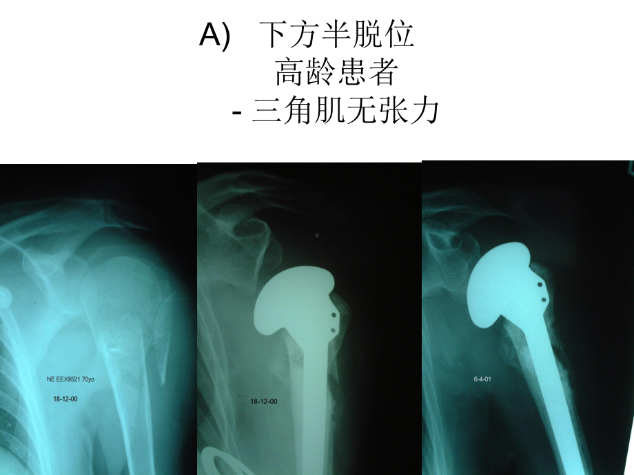 肱骨近端骨折的并发症和后遗症课件.ppt_第3页