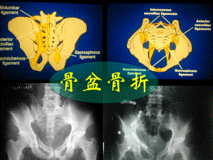 骨盆损伤课件.pptx