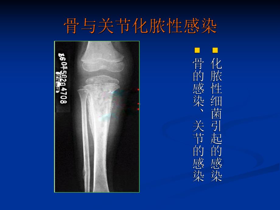 骨与关节化脓性感染课件1.ppt_第3页