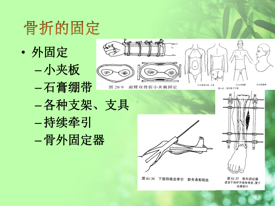 骨科外固定架的护理PPT课件.ppt_第3页