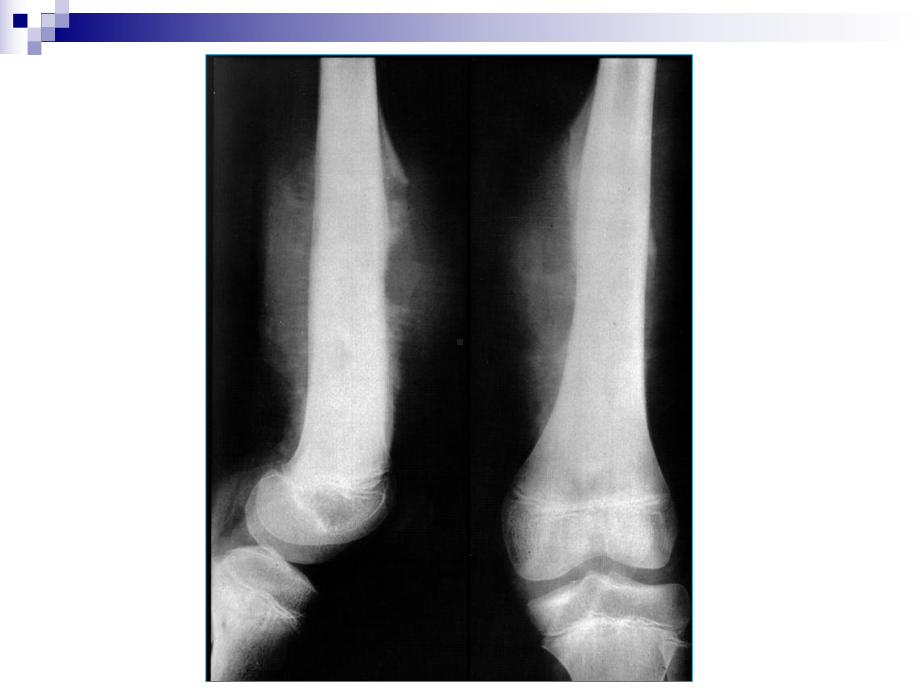 骨肿瘤讲解培训课件.ppt_第2页