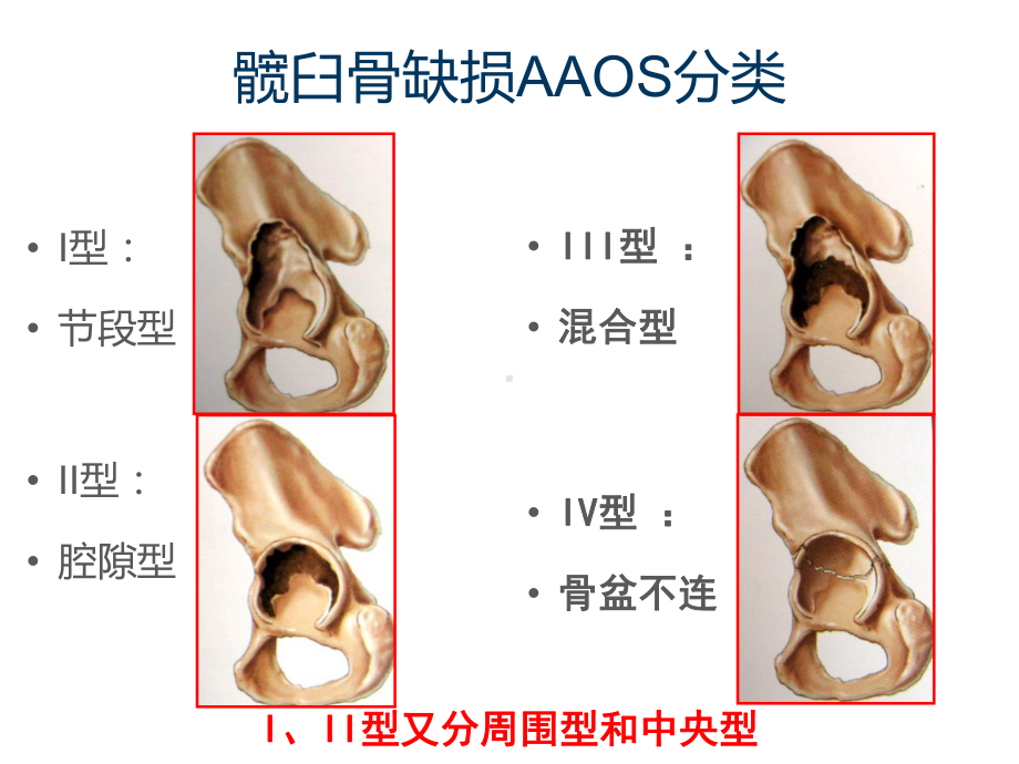 髋臼及股骨骨缺损的分型及评价-ppt课件.ppt_第3页