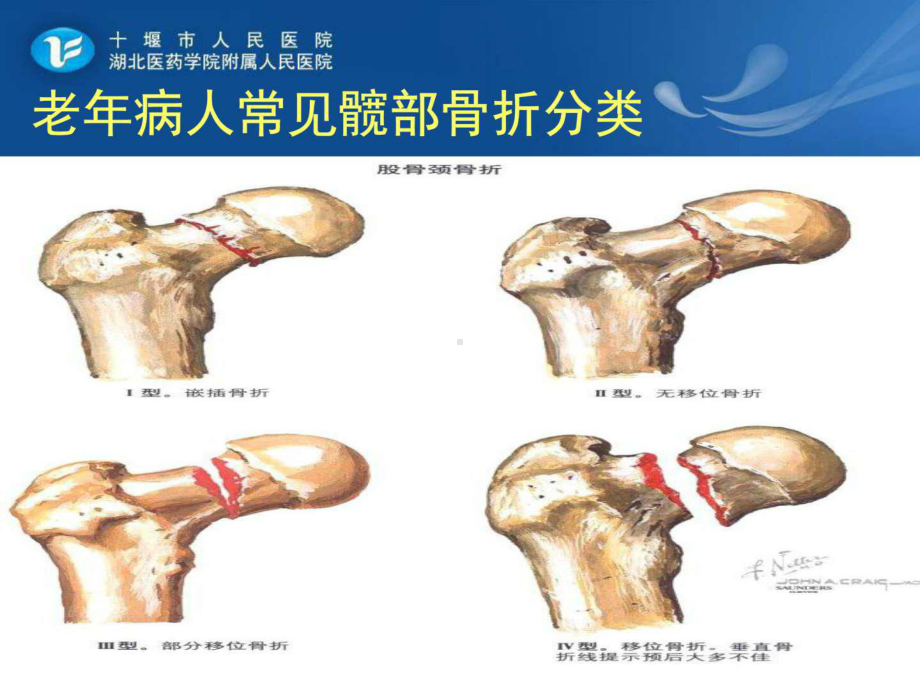 老年髋部骨折患者的护理-图文课件.ppt_第3页