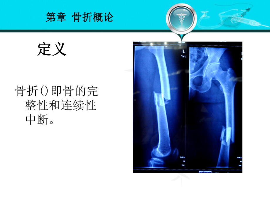 骨折概论外科学第八版课件.ppt_第2页