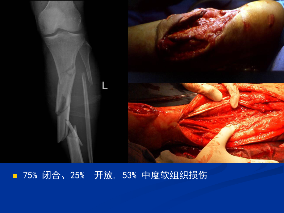 胫腓骨骨折急诊处理课件.ppt_第3页