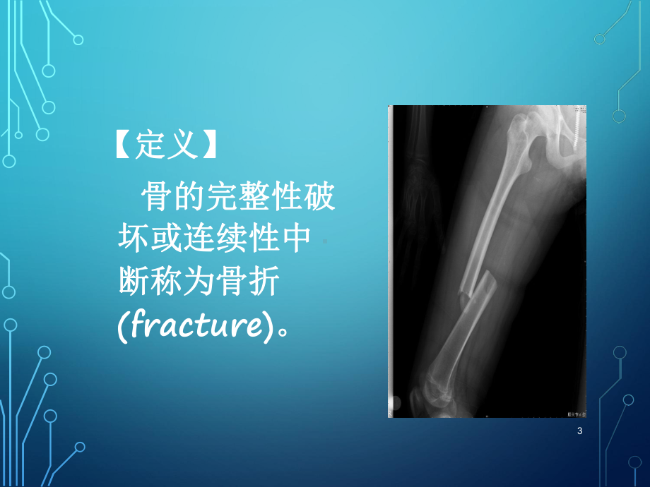 骨折概述PPT课件.ppt_第3页