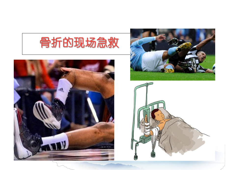 现场急救之骨折PPT课件.ppt_第1页