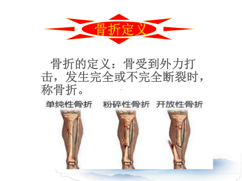 现场急救之骨折PPT课件.ppt_第2页