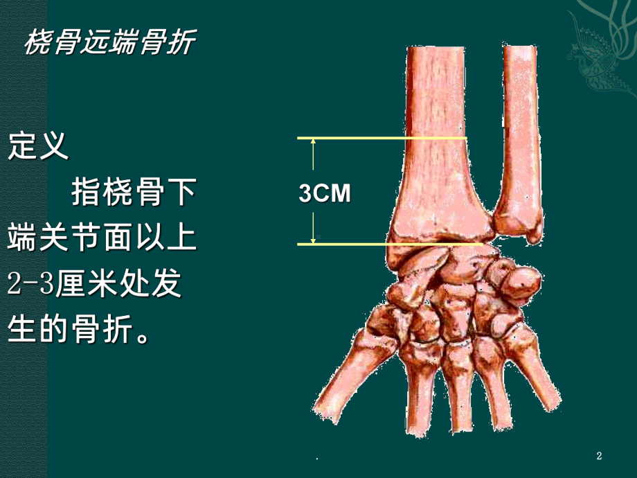 桡骨远端骨折课件PPT课件1.ppt_第2页