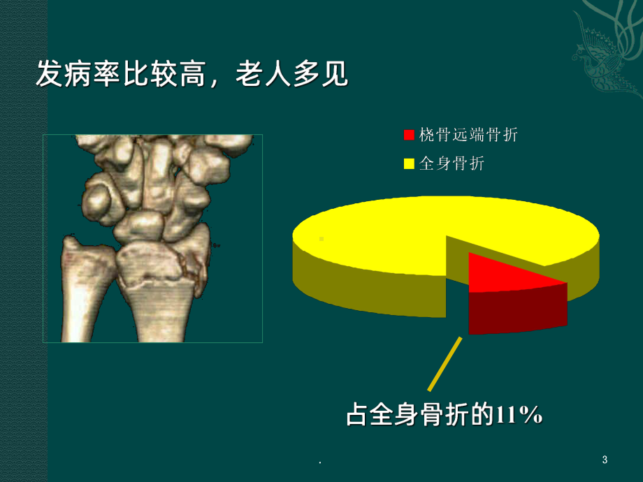 桡骨远端骨折课件PPT课件1.ppt_第3页