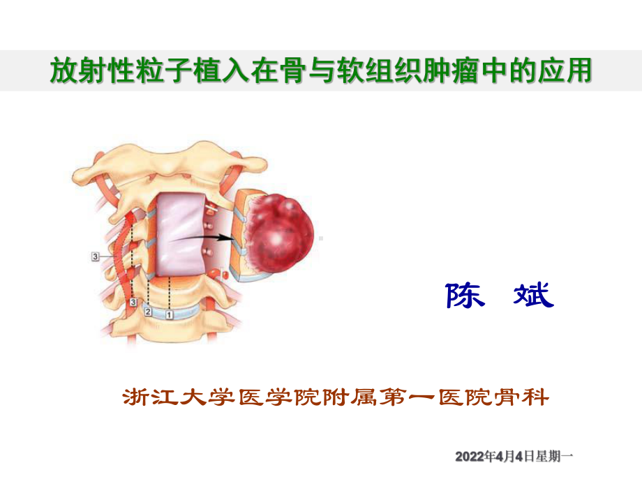 放射性粒子植入在骨与-课件.ppt_第1页