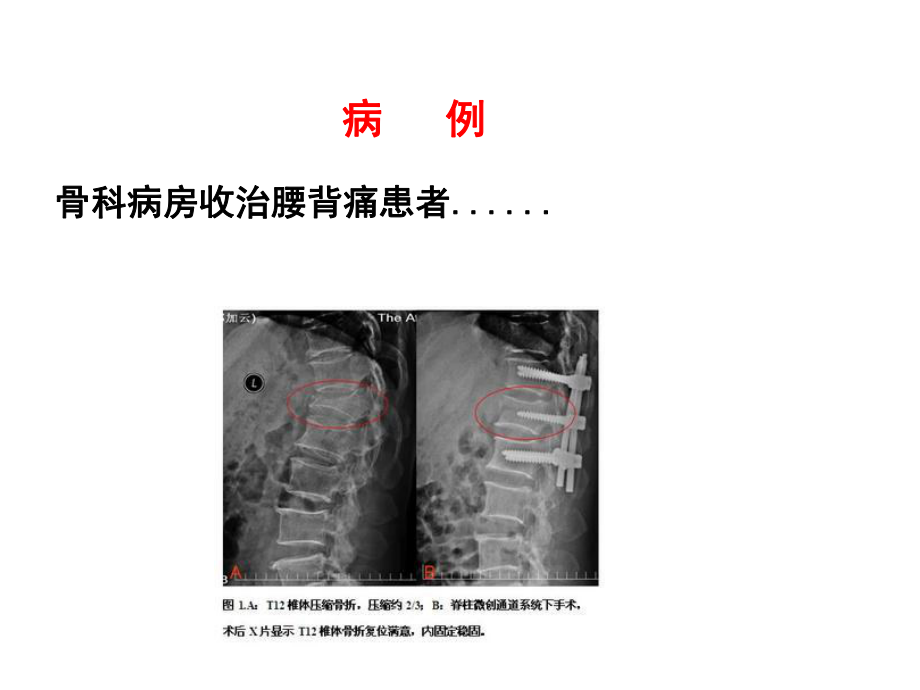 (血液内科课件）10.2多发性骨髓瘤（1学时）.ppt_第2页