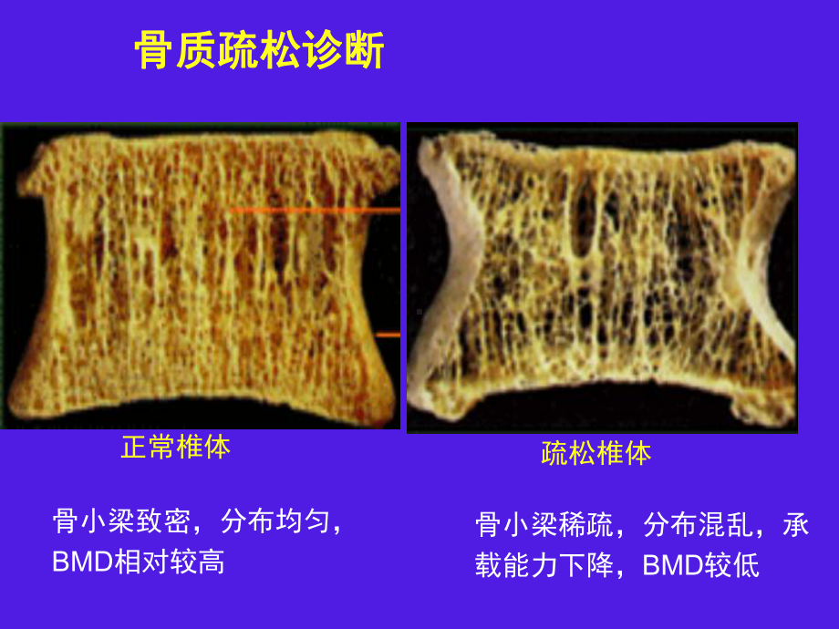 骨质疏松诊断和骨转换指标课件.ppt_第2页