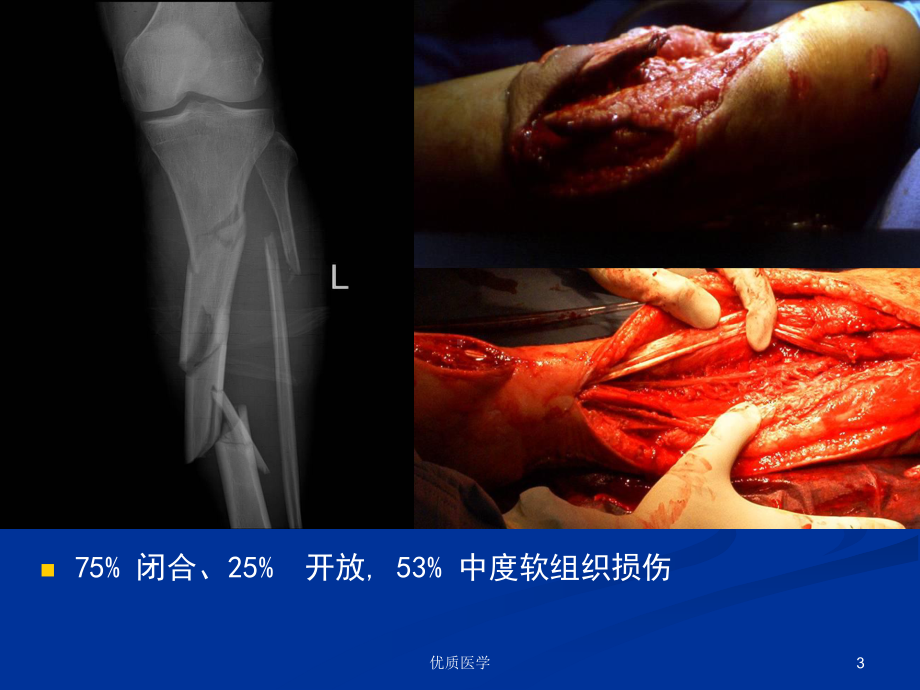 胫腓骨骨折急诊处理[详尽整齐]课件.ppt_第3页