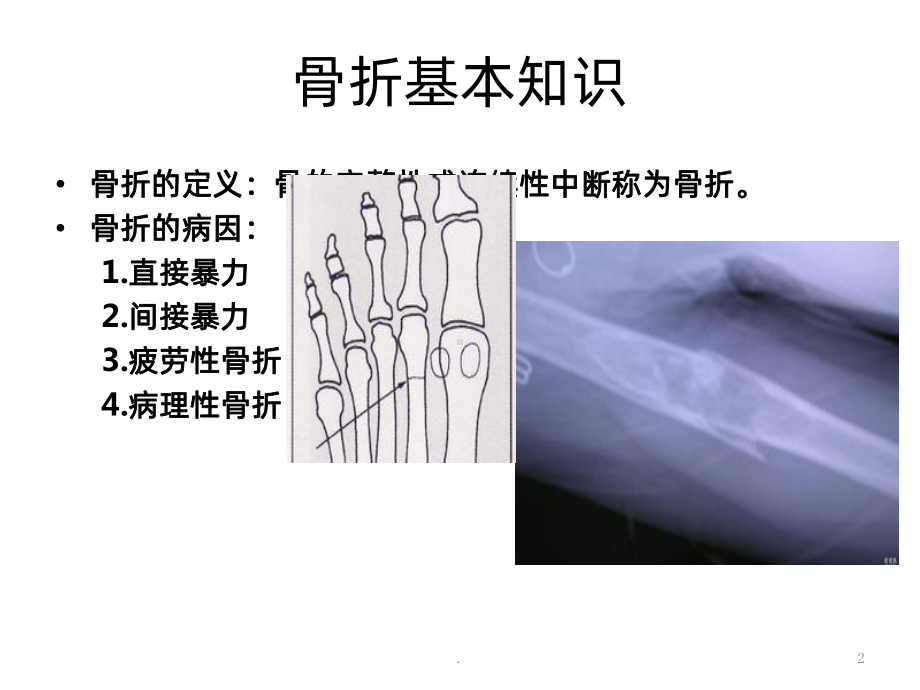 胫腓骨骨折ppt课件1.ppt_第2页