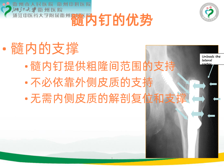 治疗股骨转子间骨折牵引床手术体位技巧ppt课件.ppt_第2页