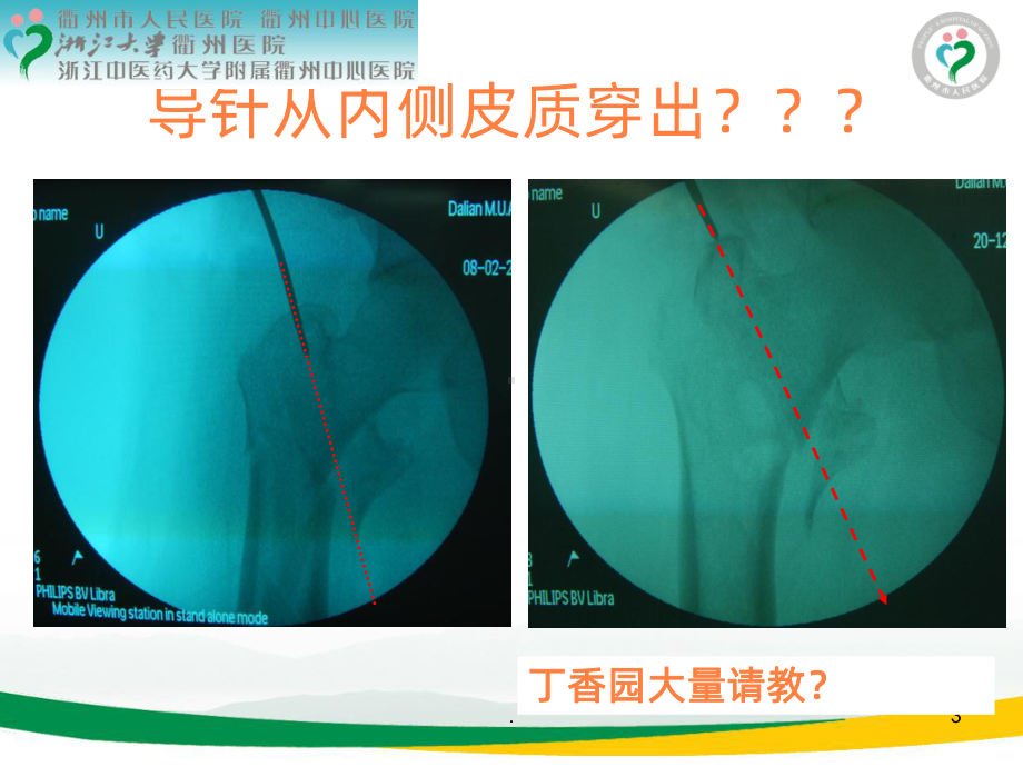 治疗股骨转子间骨折牵引床手术体位技巧ppt课件.ppt_第3页