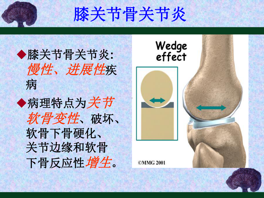 膝骨关节炎的防治精品课件-精品.ppt_第2页