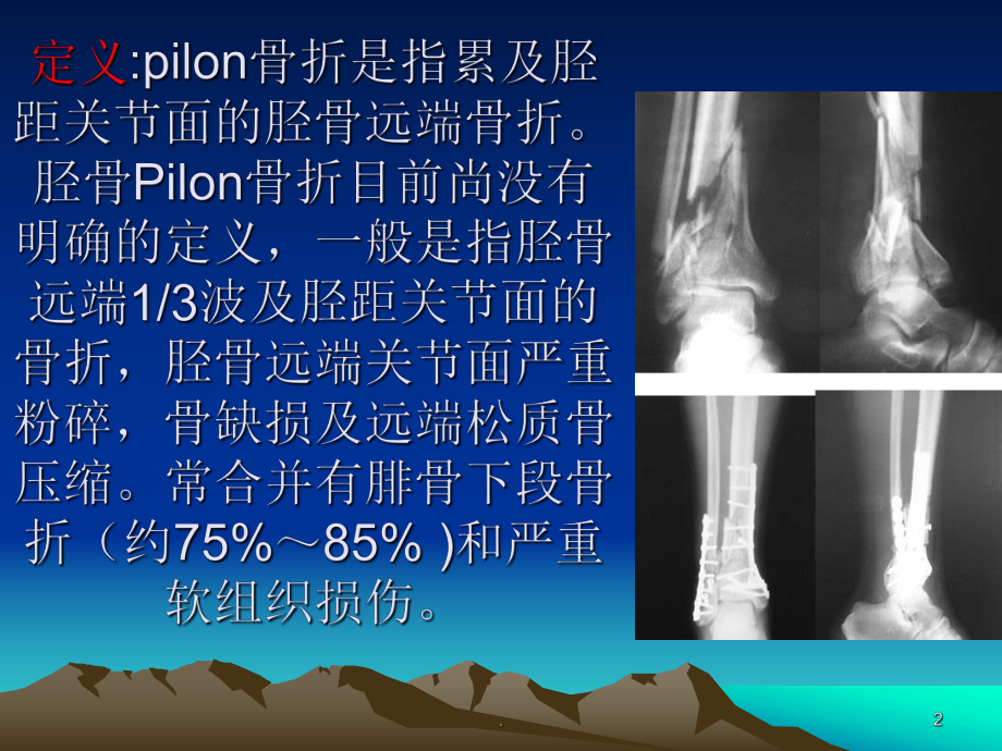 Pilon骨折ppt演示课件.ppt_第2页