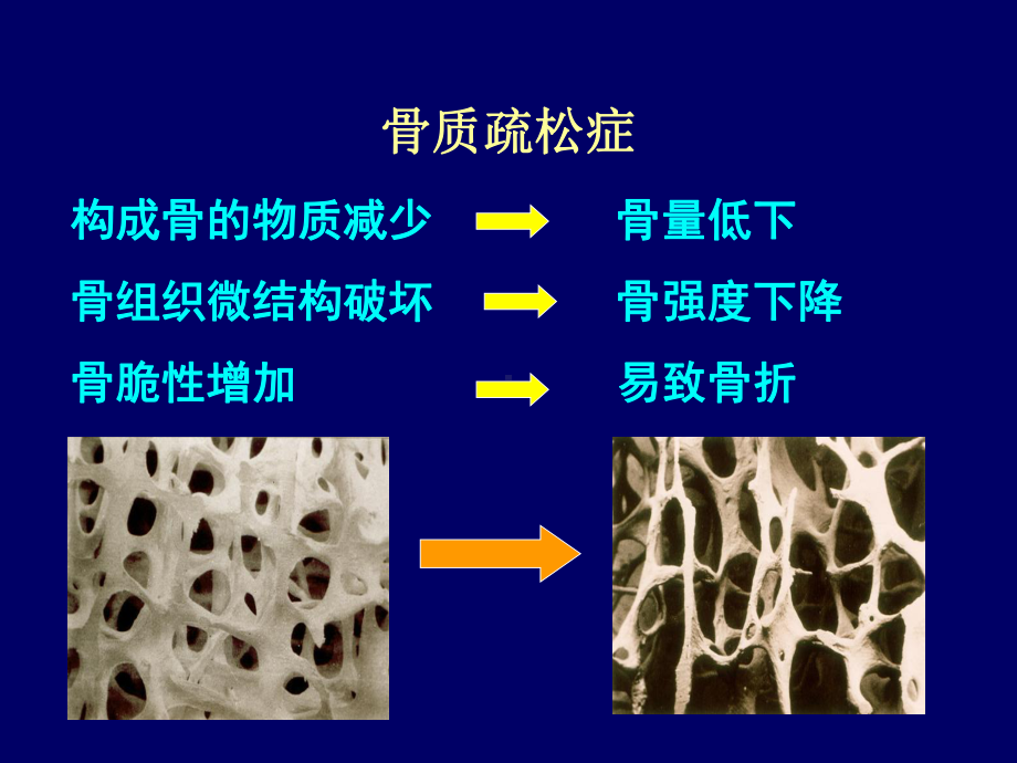 原发性骨质疏松症课件.ppt_第3页