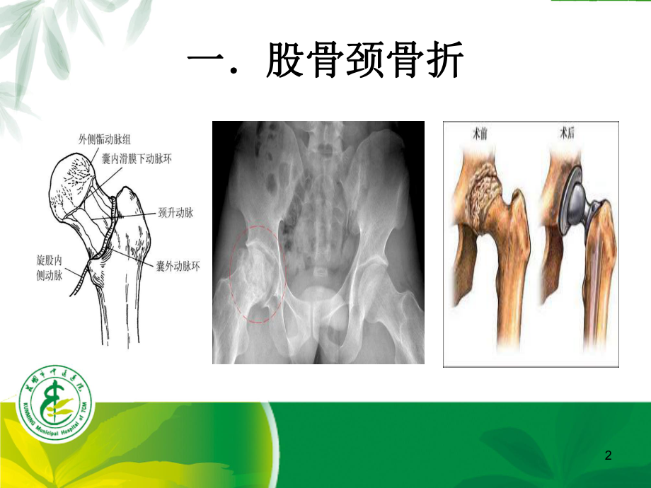 股骨颈骨折手术患者多模式镇痛治疗课件.ppt_第2页