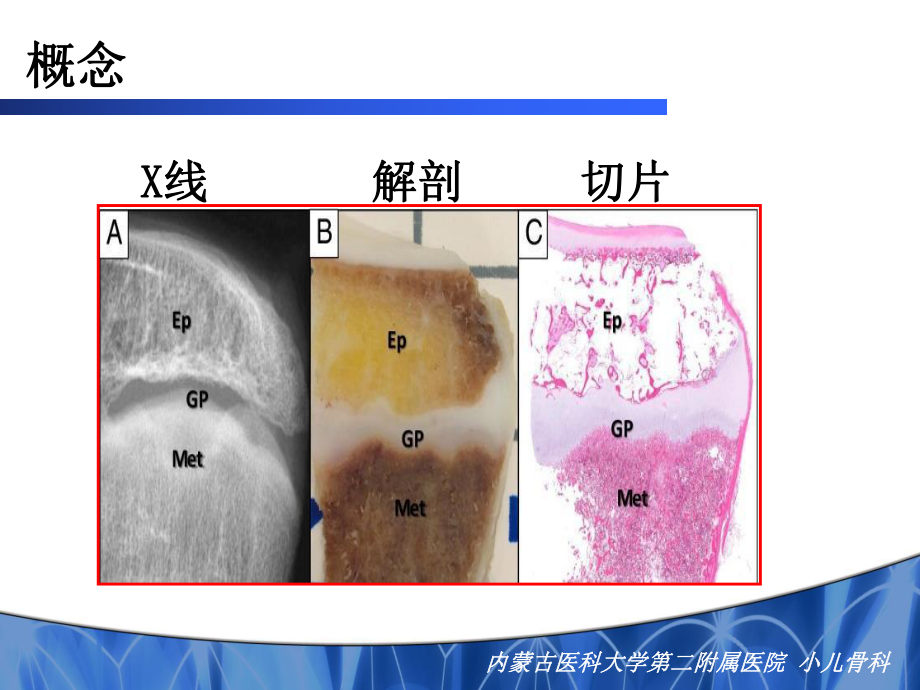 儿童骨骺损伤的特点及其治疗原则课件.ppt_第3页