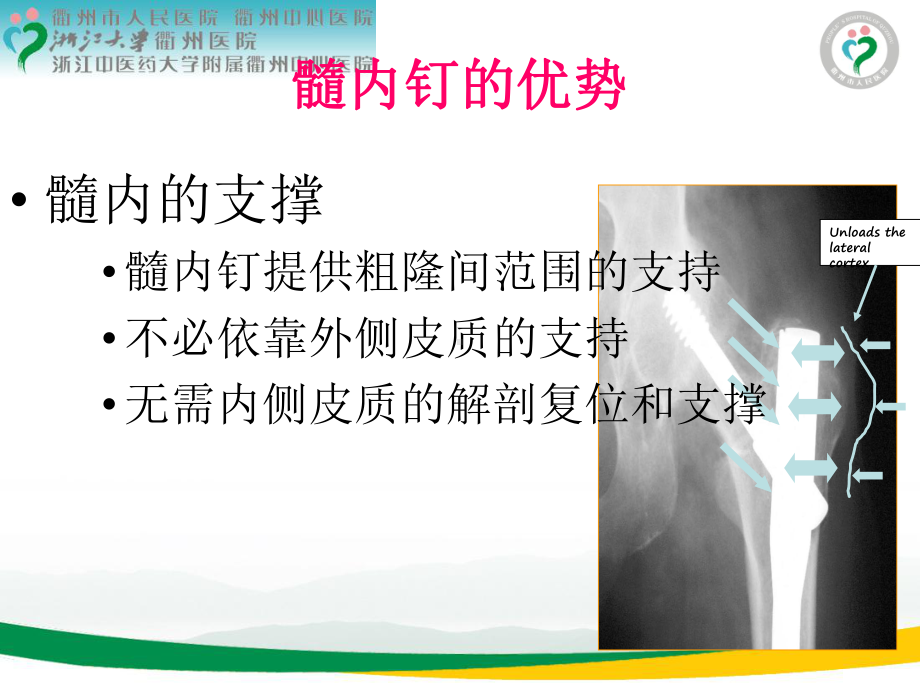 pfna治疗股骨转子间骨折牵引床手术体位技巧 ppt课件.ppt.ppt_第2页