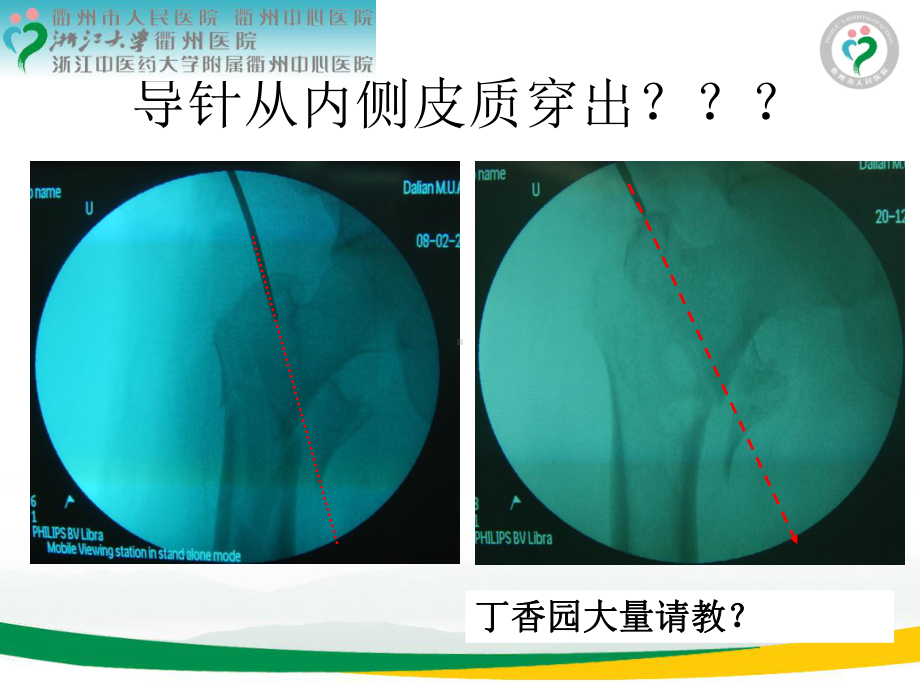 pfna治疗股骨转子间骨折牵引床手术体位技巧 ppt课件.ppt.ppt_第3页