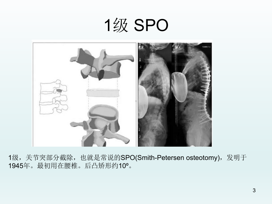 脊柱截骨术PPT课件.ppt_第3页