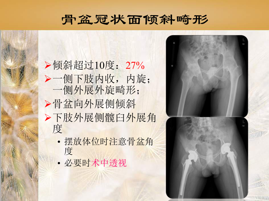 髋关节骨性强直骨盆及髋臼畸形及手术对策课件.ppt_第3页