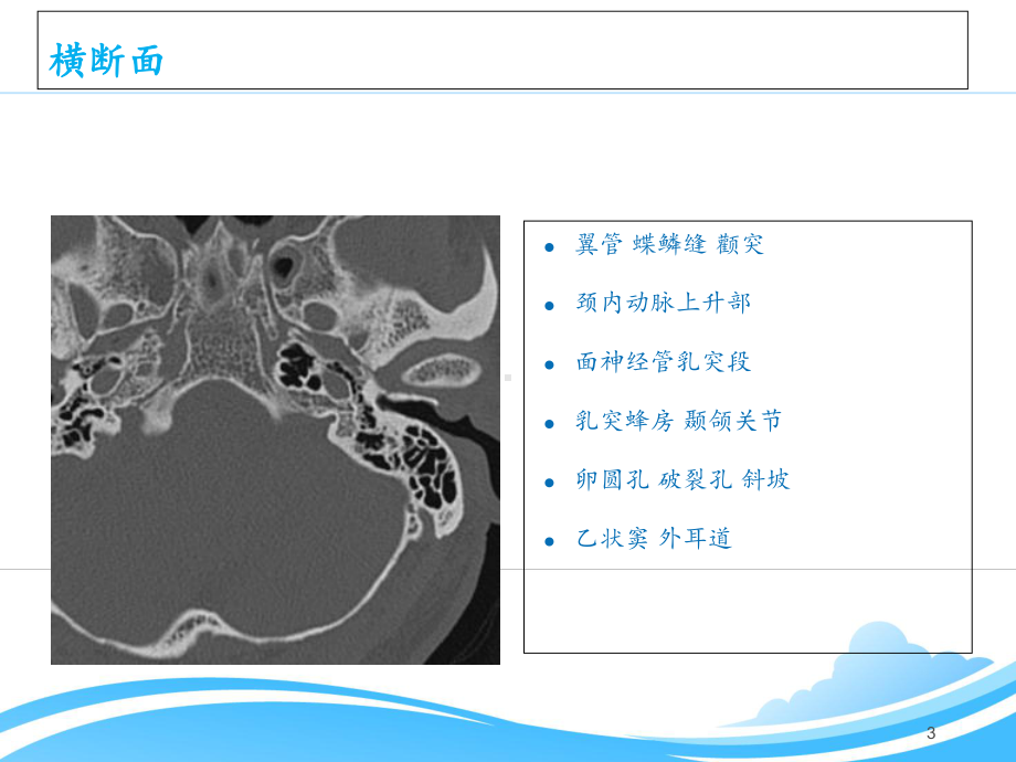 颞骨CT影像解剖-ppt课件.ppt_第3页