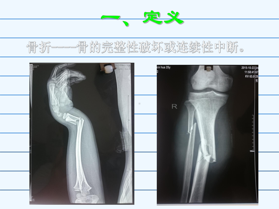 骨折概论课件.ppt_第3页