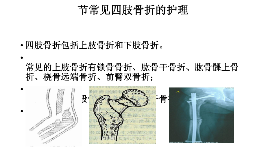 常见四肢骨折护理课件.ppt_第1页