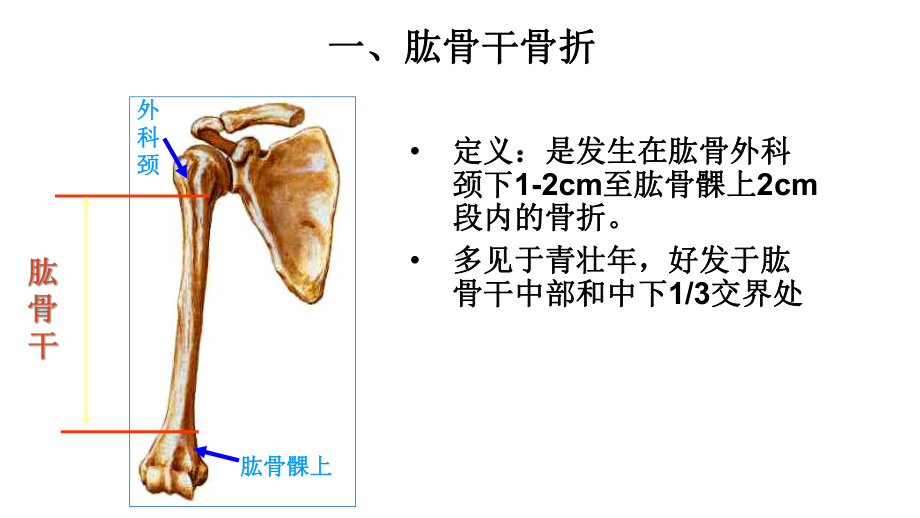 常见四肢骨折护理课件.ppt_第2页