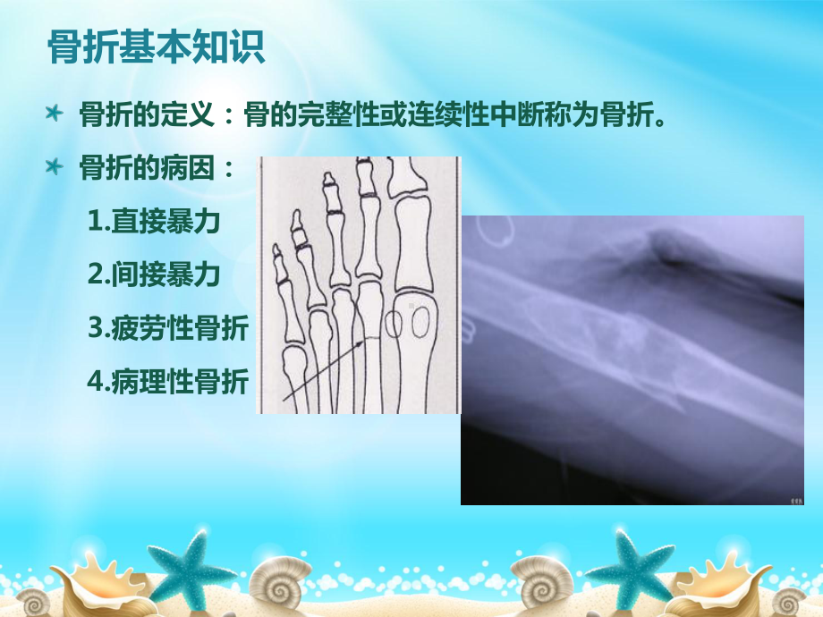 胫腓骨骨折1课件.ppt_第2页