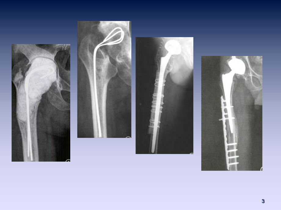 髋关节假体周围骨折的诊治PPT培训课件.ppt_第3页