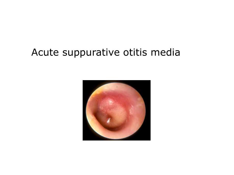 耳鼻咽喉科学英文版课件 acute suppurative otitis media.ppt_第1页